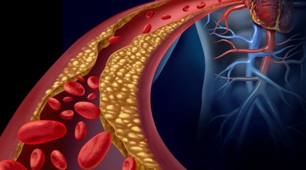 ¿Qué es la Dislipemia o colesterol alto?